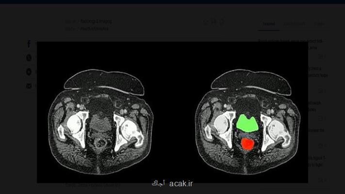 بزرگترین مخزن داده سی تی اسکن برای ردیابی سریع سرطان